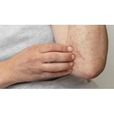 Urticaria crónica: síntomas y cómo afecta la calidad de vida