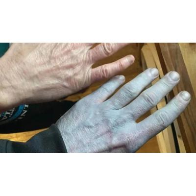 Se despierta con la piel azul, va al hospital y muere de vergüenza al saber qué le pasa
