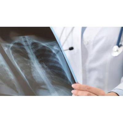 Millones de personas tienen la bacteria que causa la tuberculosis sin saberlo