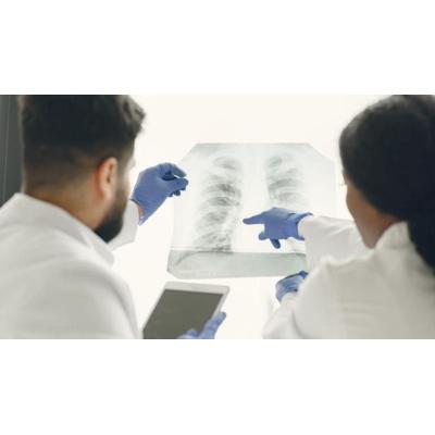Un estudio internacional crea una herramienta que predice la mortalidad a largo plazo tras una neumonía