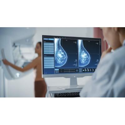 Usar radioterapia en vez de cirugía puede reducir el linfedema en cáncer de mama, según un estudio