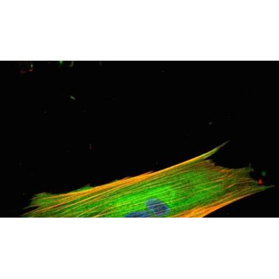 Una proteína determina si los pacientes de cáncer colorrectal pueden recibir inmunoterapia