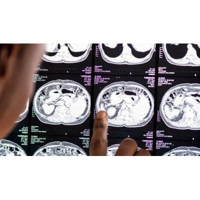 Un nuevo medicamento anticoagulante reduce el riesgo de accidente cerebrovascular sin aumentar el riesgo de hemorragia