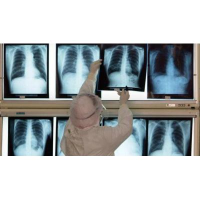 Mejorar la higiene bucal reduce a más de la mitad el riesgo de neumonía intrahospitalaria